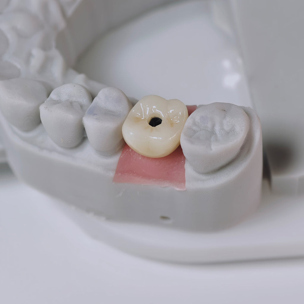 Zirconia Crown With Screw Retained