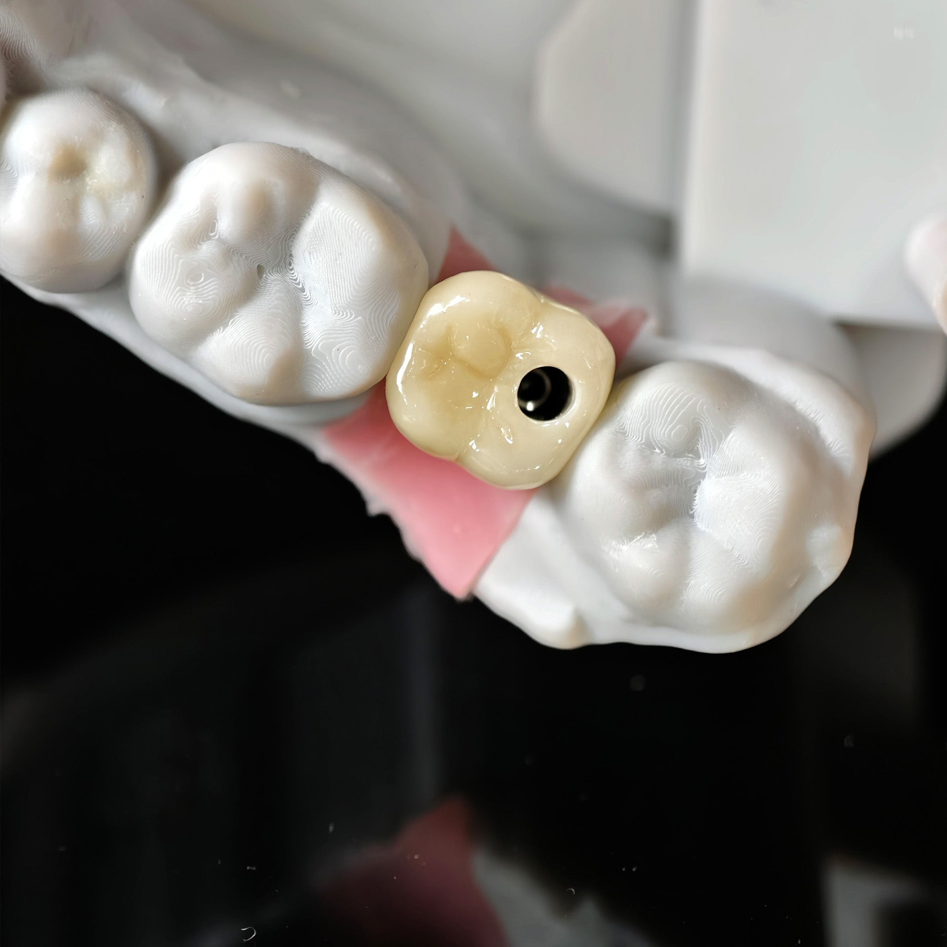 Zirconia Crown With Screw Retained