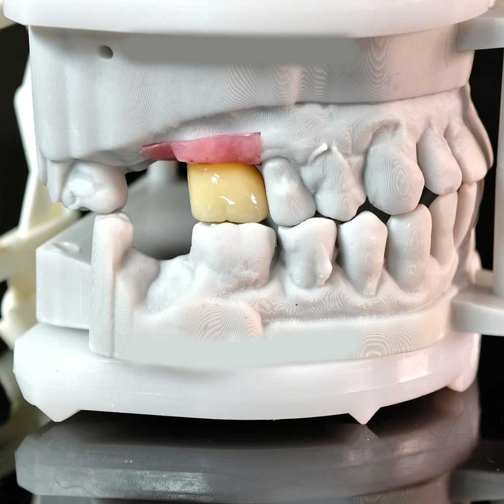 Zirconia Crown With Screw Retained
