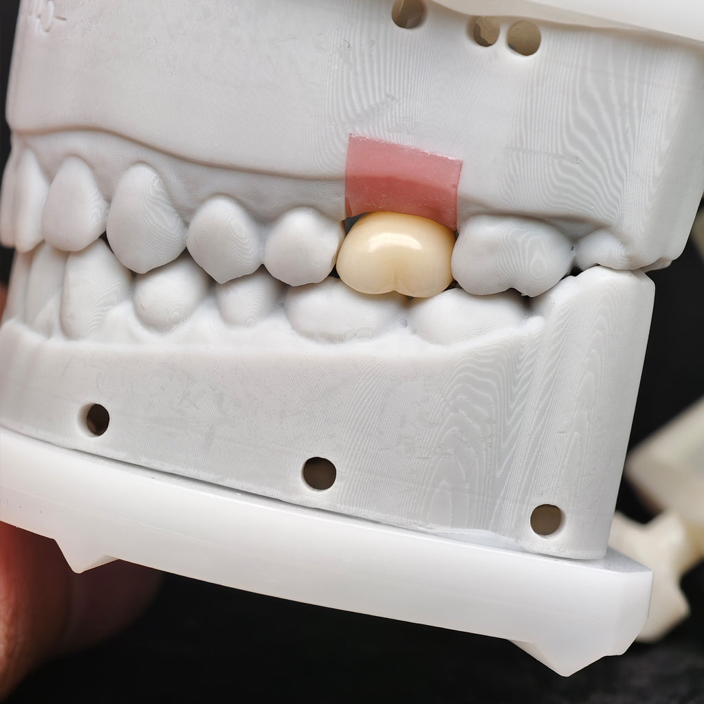 Zirconia Crown With Screw Retained