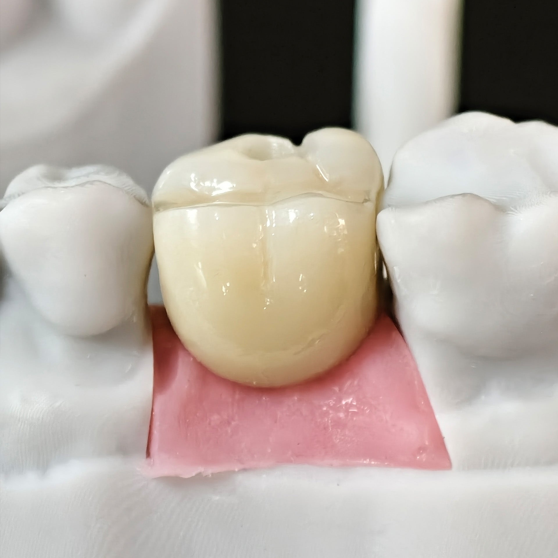 Zirconia Crown With Screw Retained
