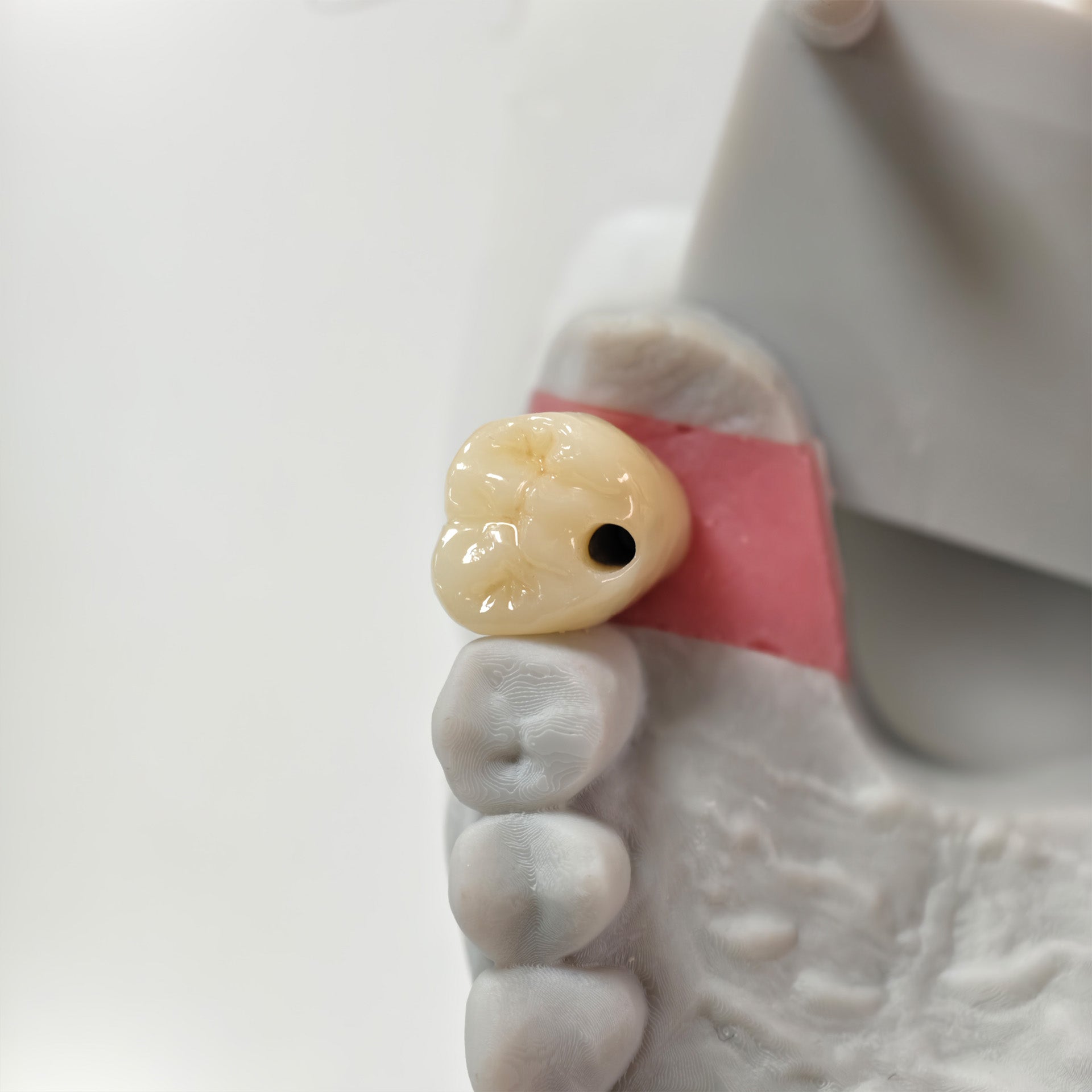 Zirconia Crown With Screw Retained