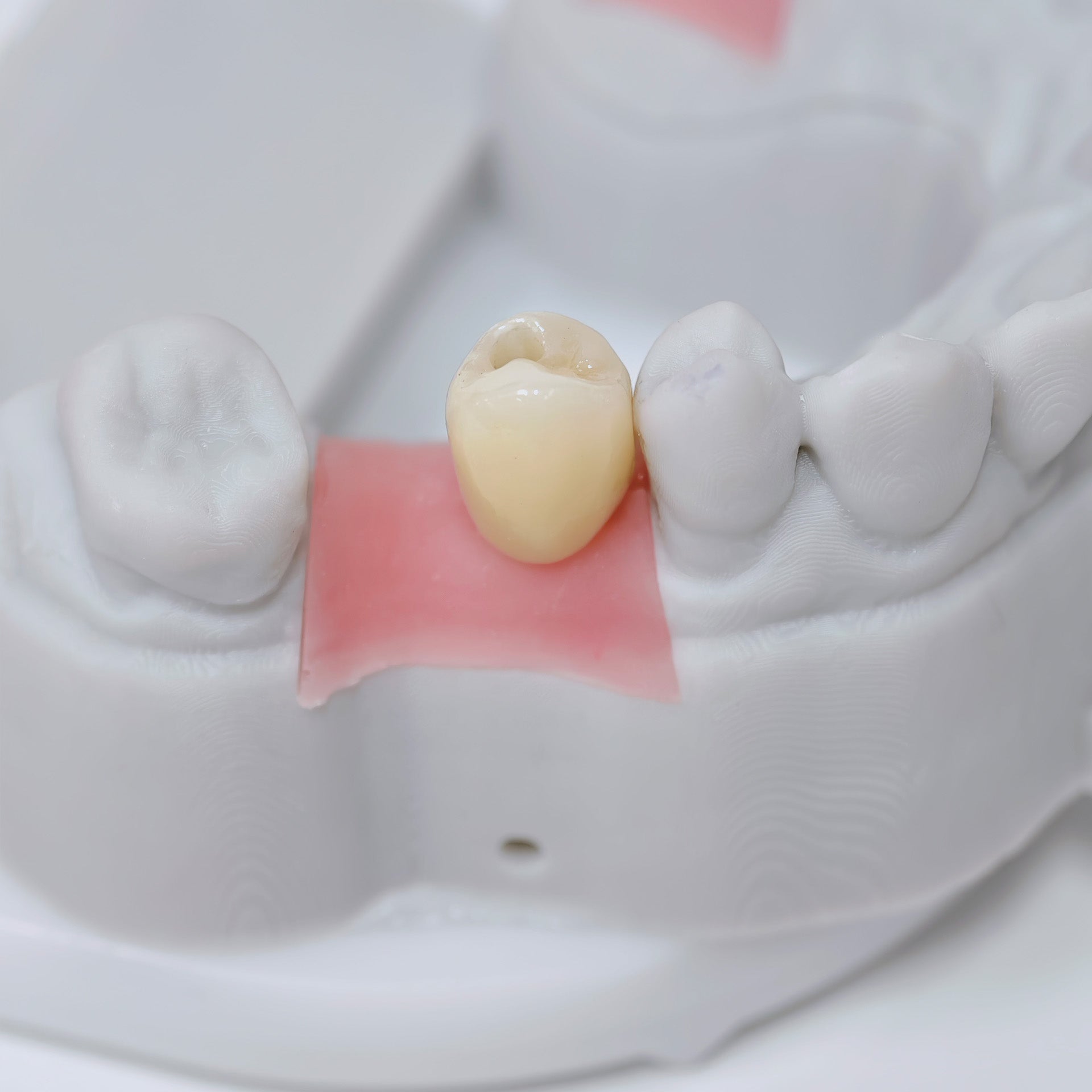 Zirconia Crown With Screw Retained