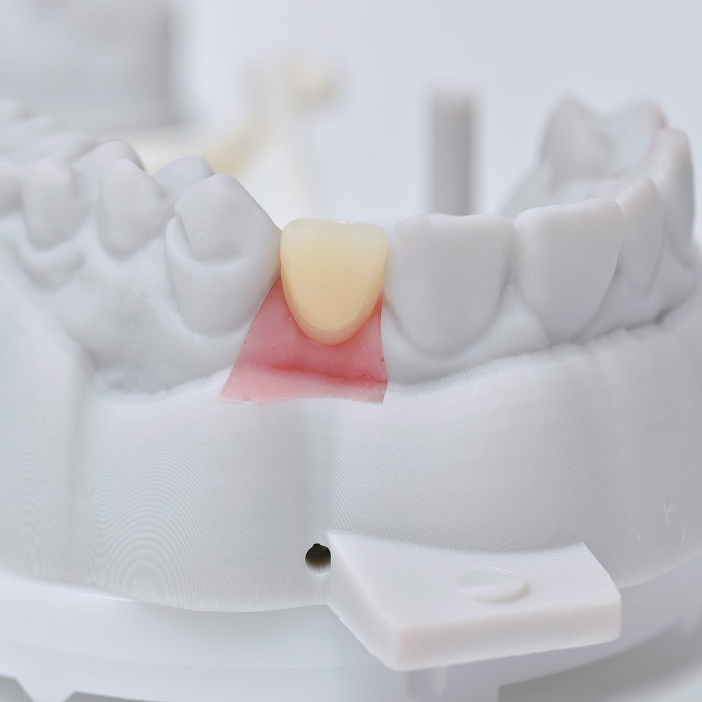 Zirconia Crown With Screw Retained
