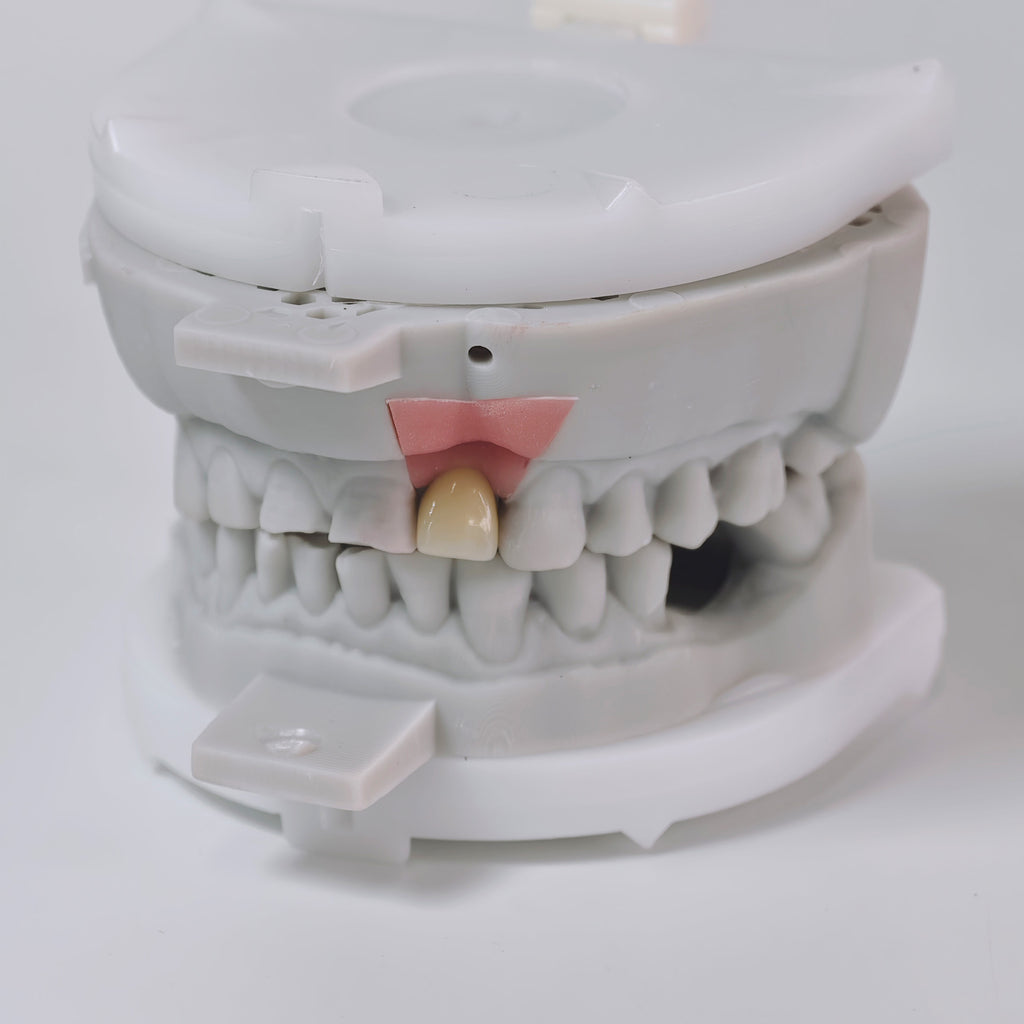 Zirconia Crown With Screw Retained