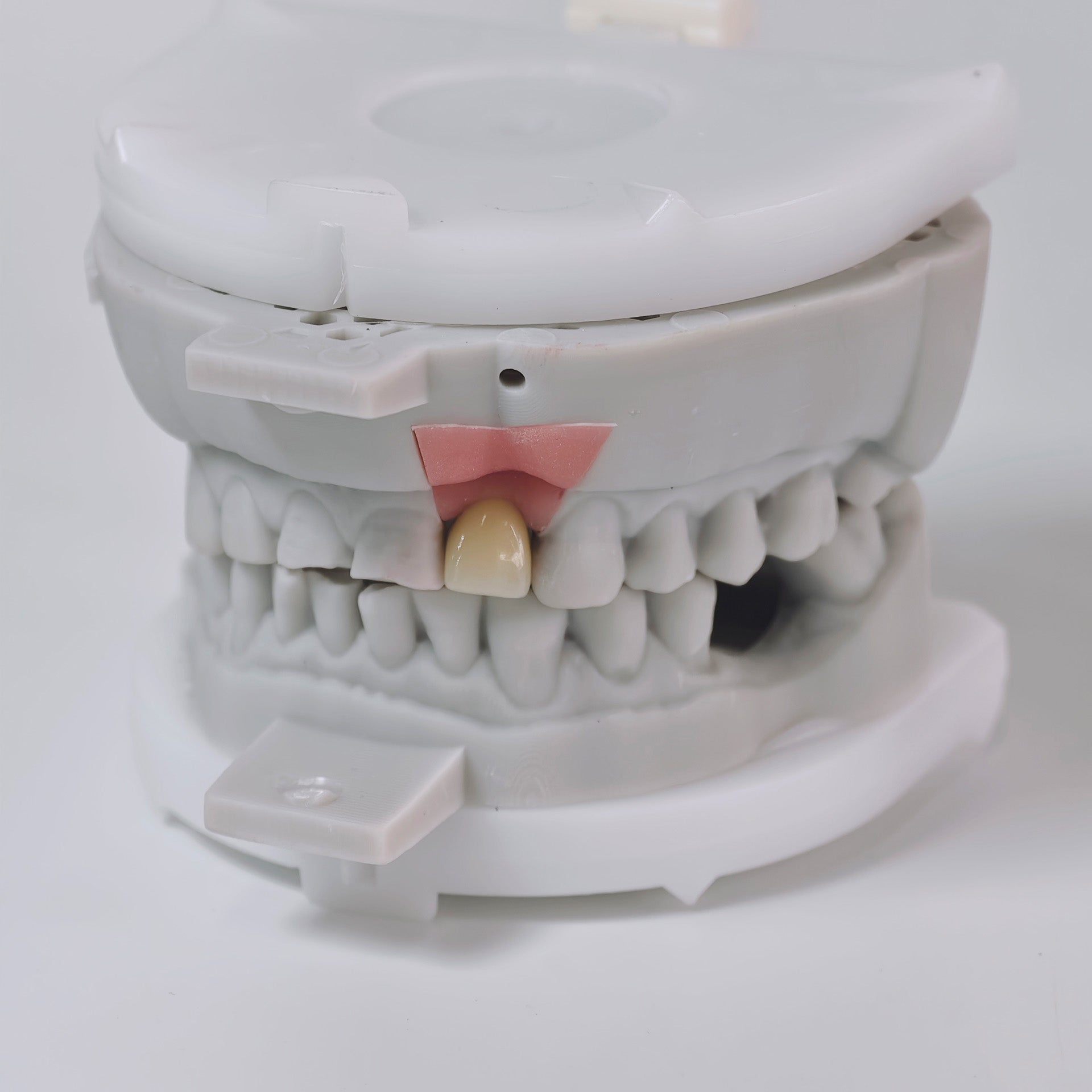 Zirconia Crown With Screw Retained