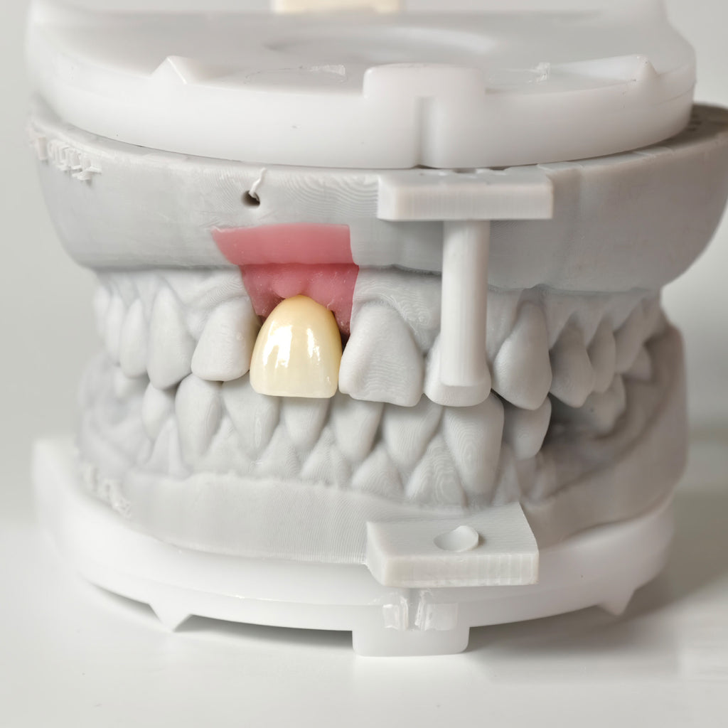 Zirconia Crown With Screw Retained