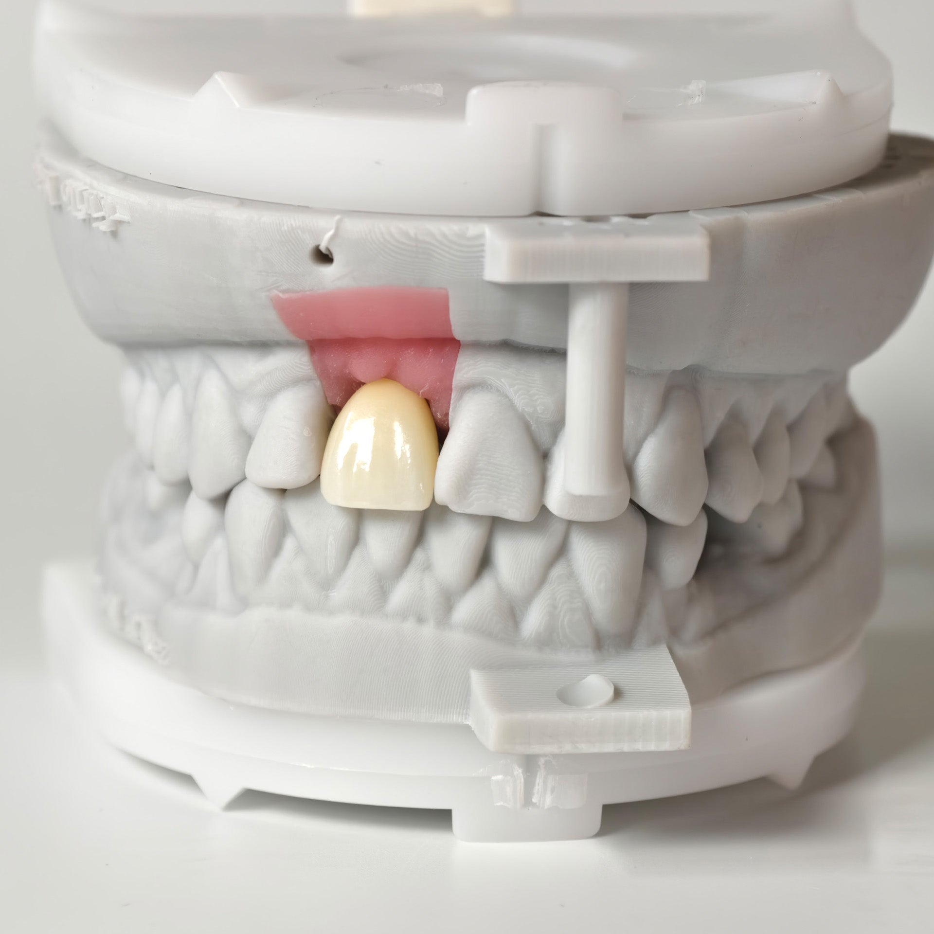 Zirconia Crown With Screw Retained