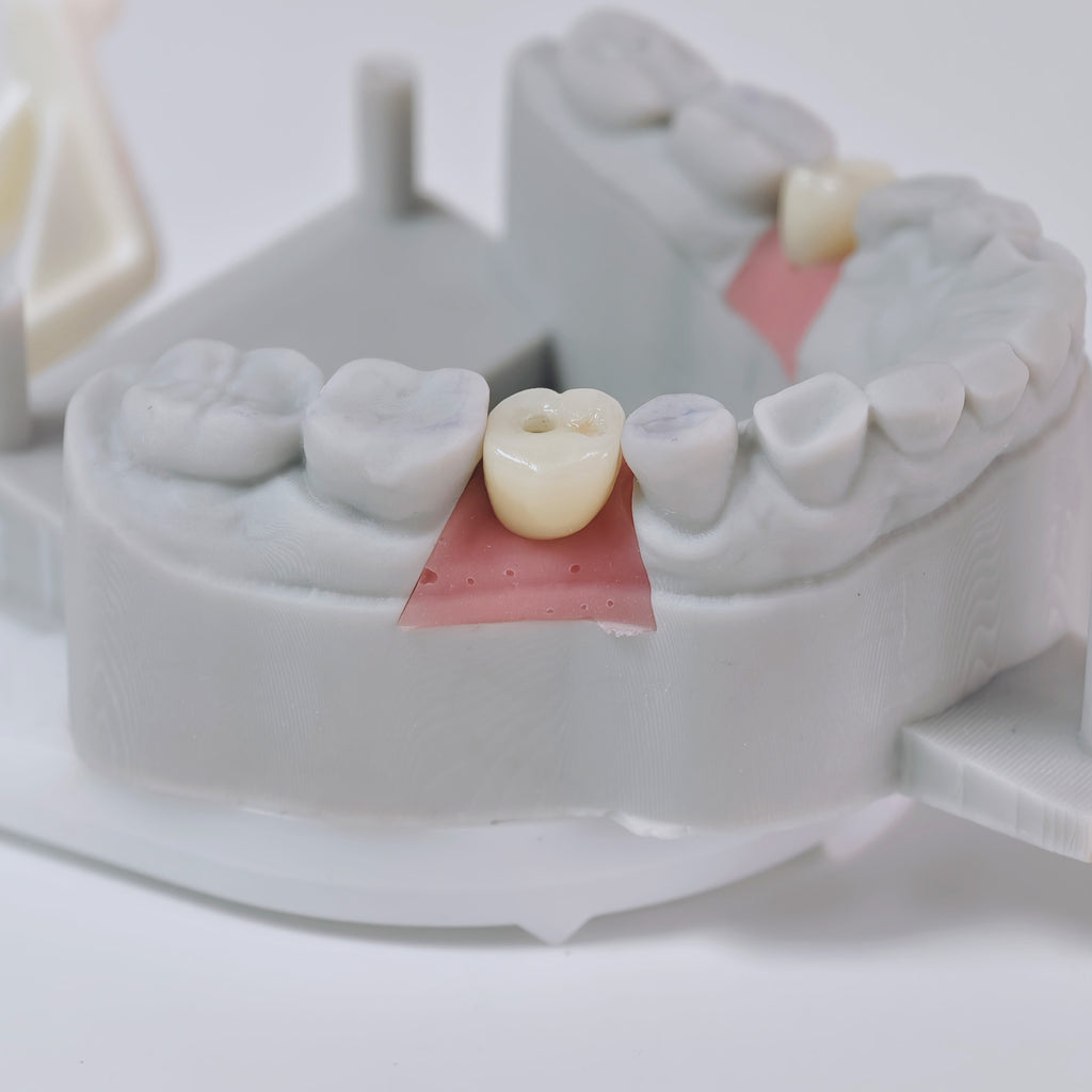 Zirconia Crown With Screw Retained