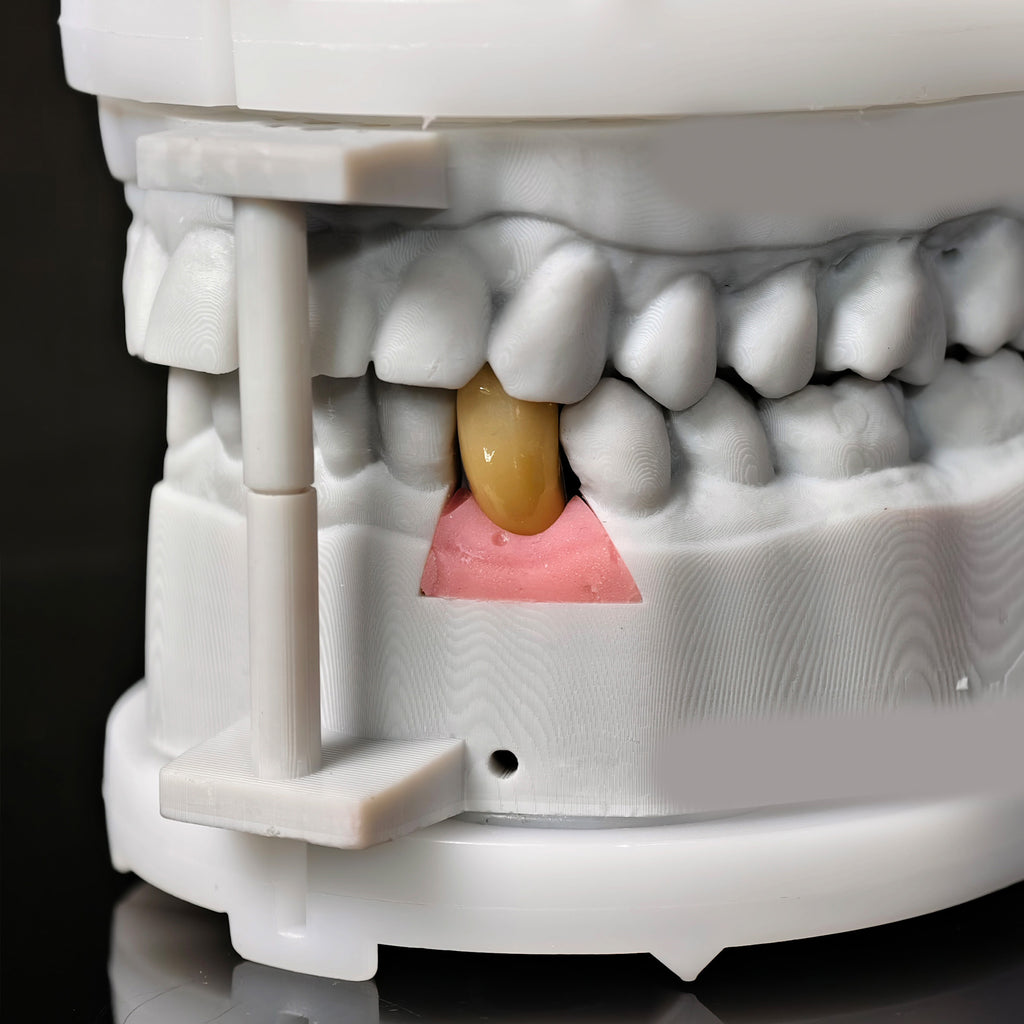 Zirconia Crown With Screw Retained