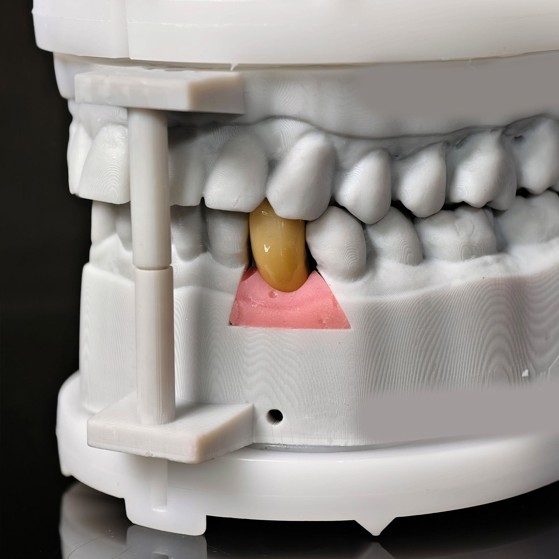 Zirconia Crown With Screw Retained