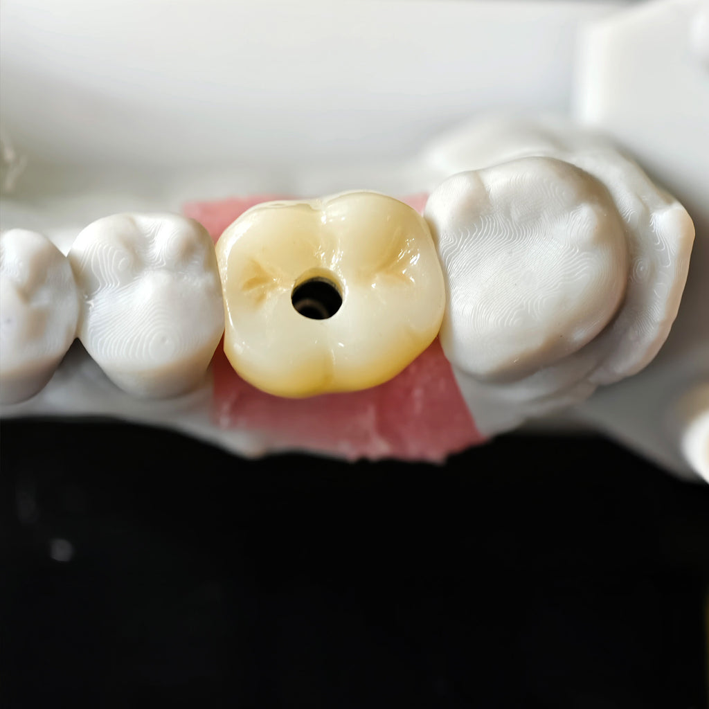 Zirconia Crown With Screw Retained