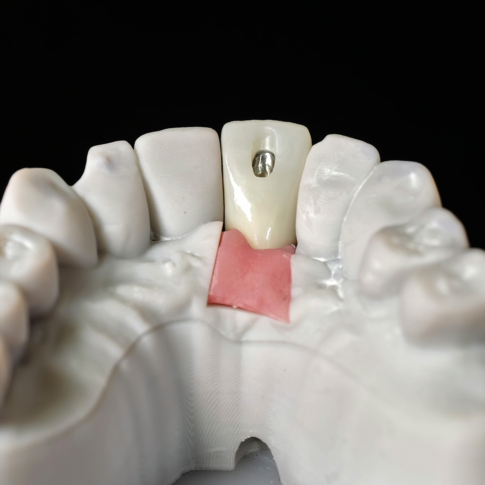 Zirconia Crown With Screw Retained
