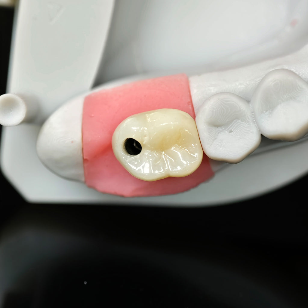 Zirconia Crown With Screw Retained