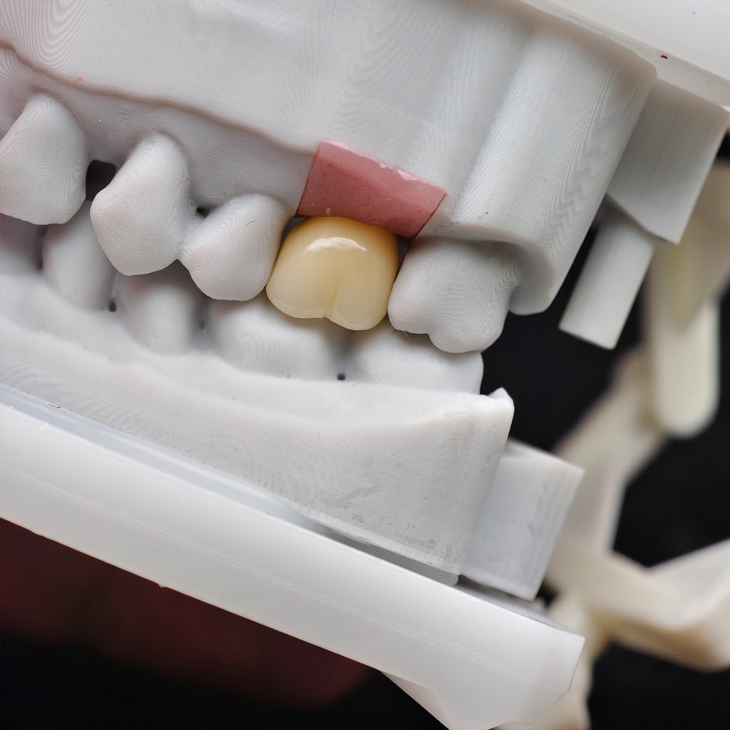 Zirconia Crown With Screw Retained