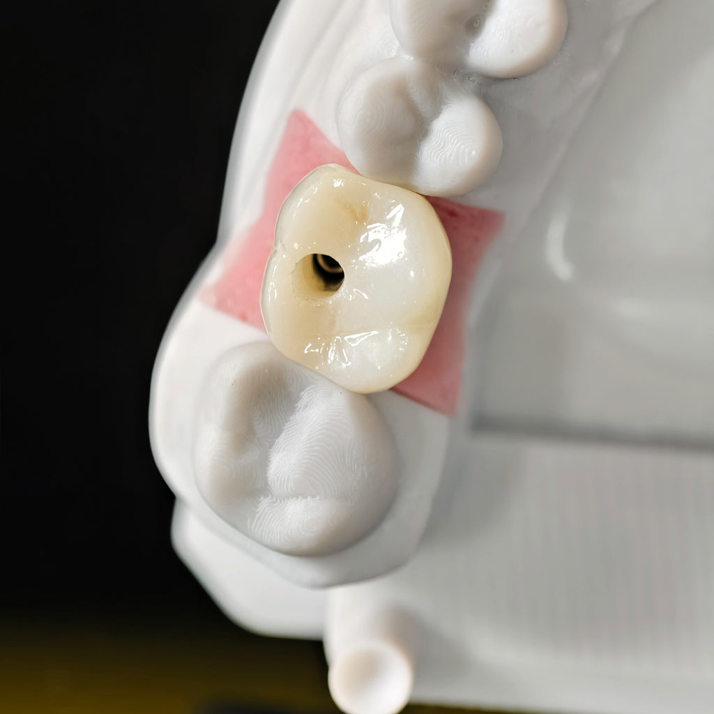 Zirconia Crown With Screw Retained