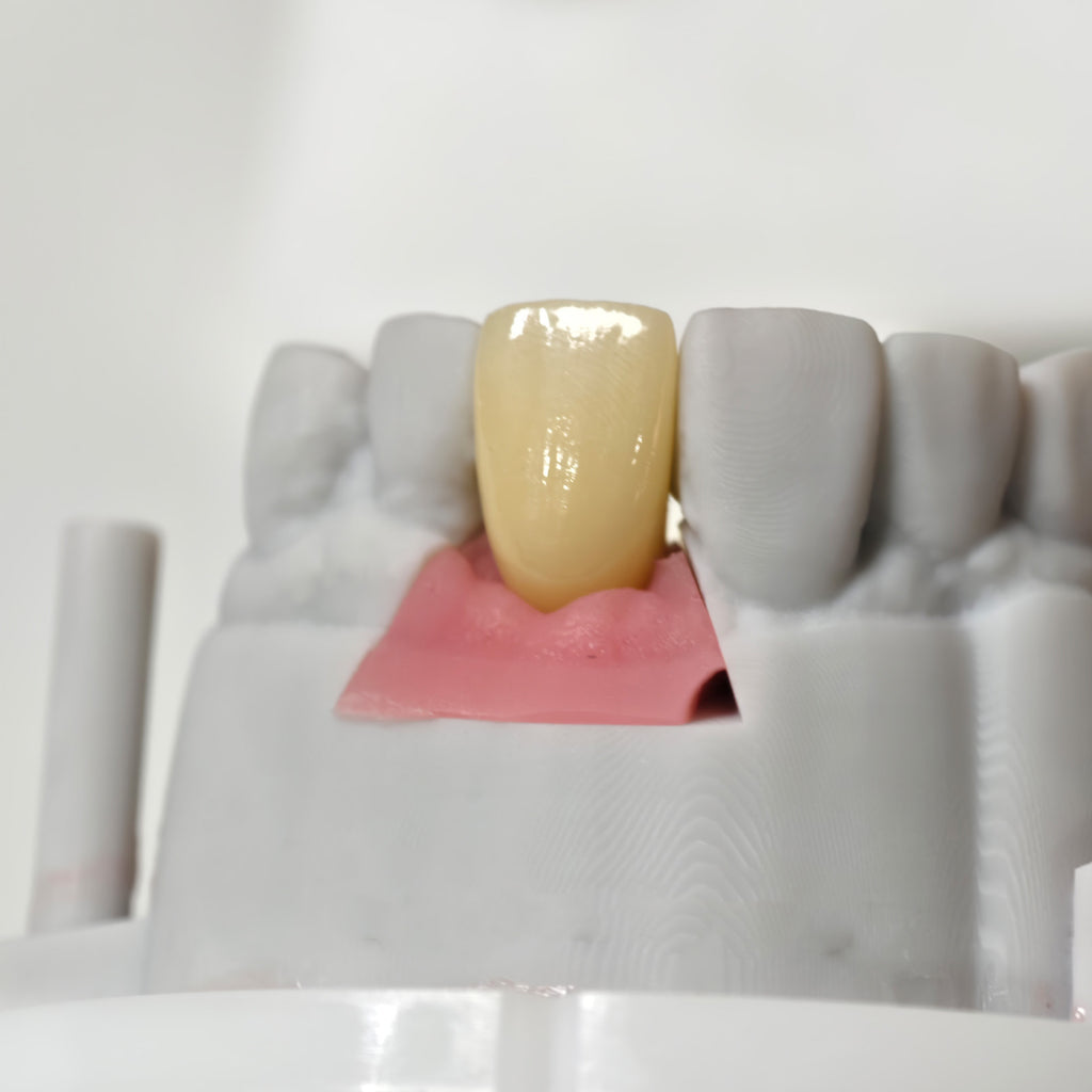 Zirconia Crown With Screw Retained