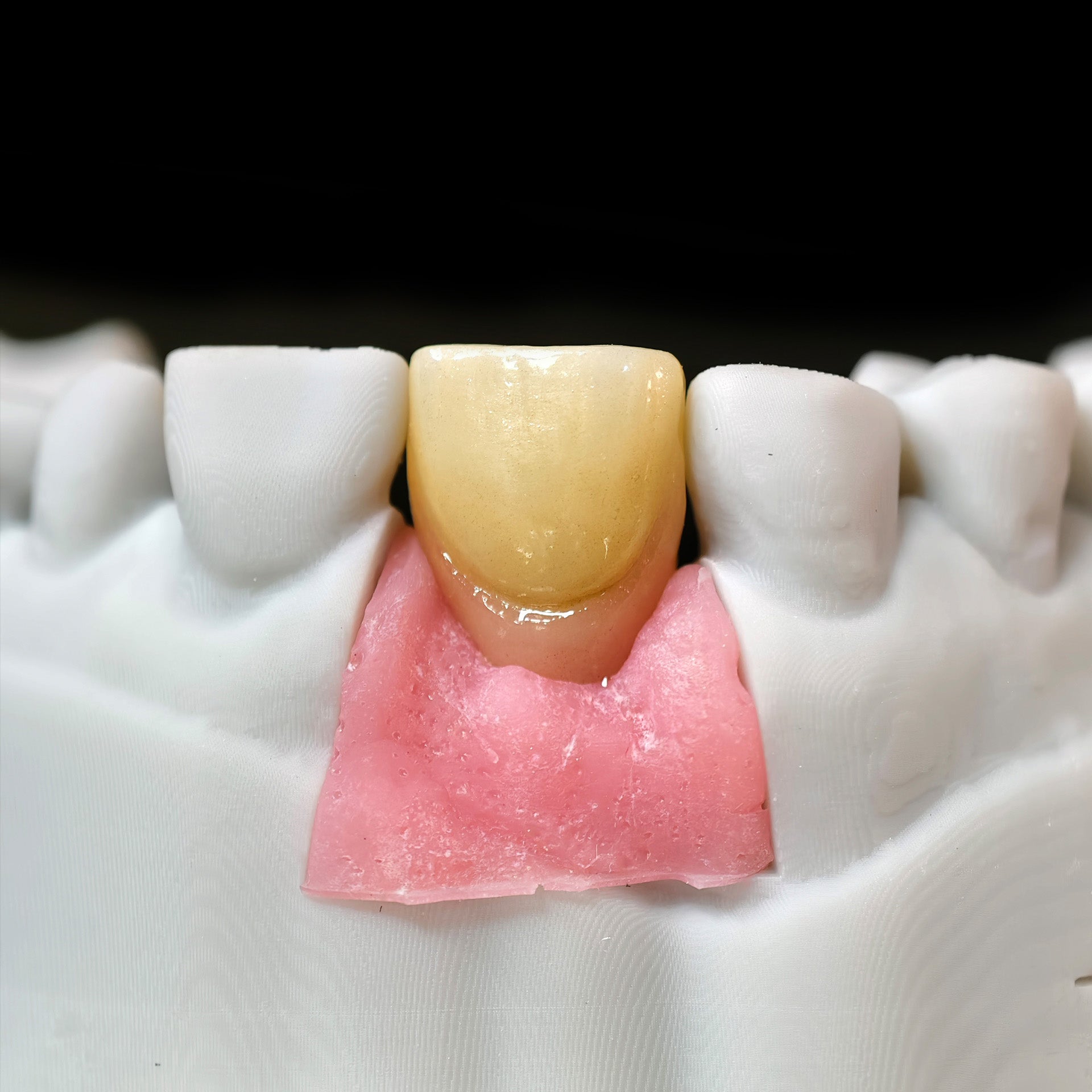 Zirconia Crown With Screw Retained