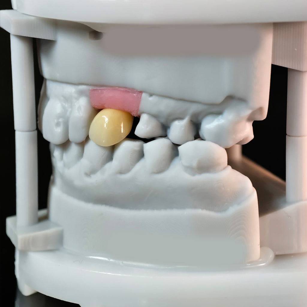 Zirconia Crown With Screw Retained