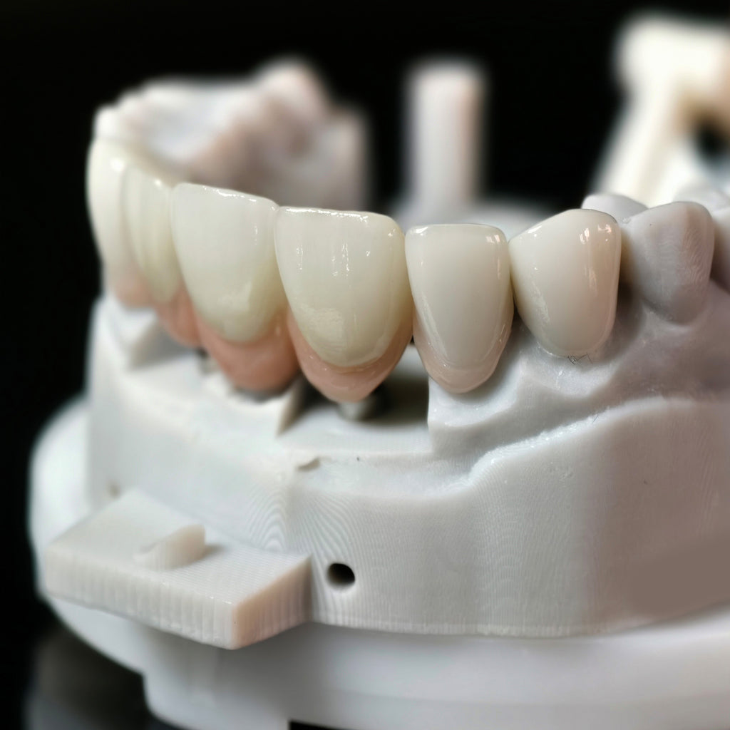 Zirconia Crown With Screw Retained And Cement Retained And Ceramic Veneers