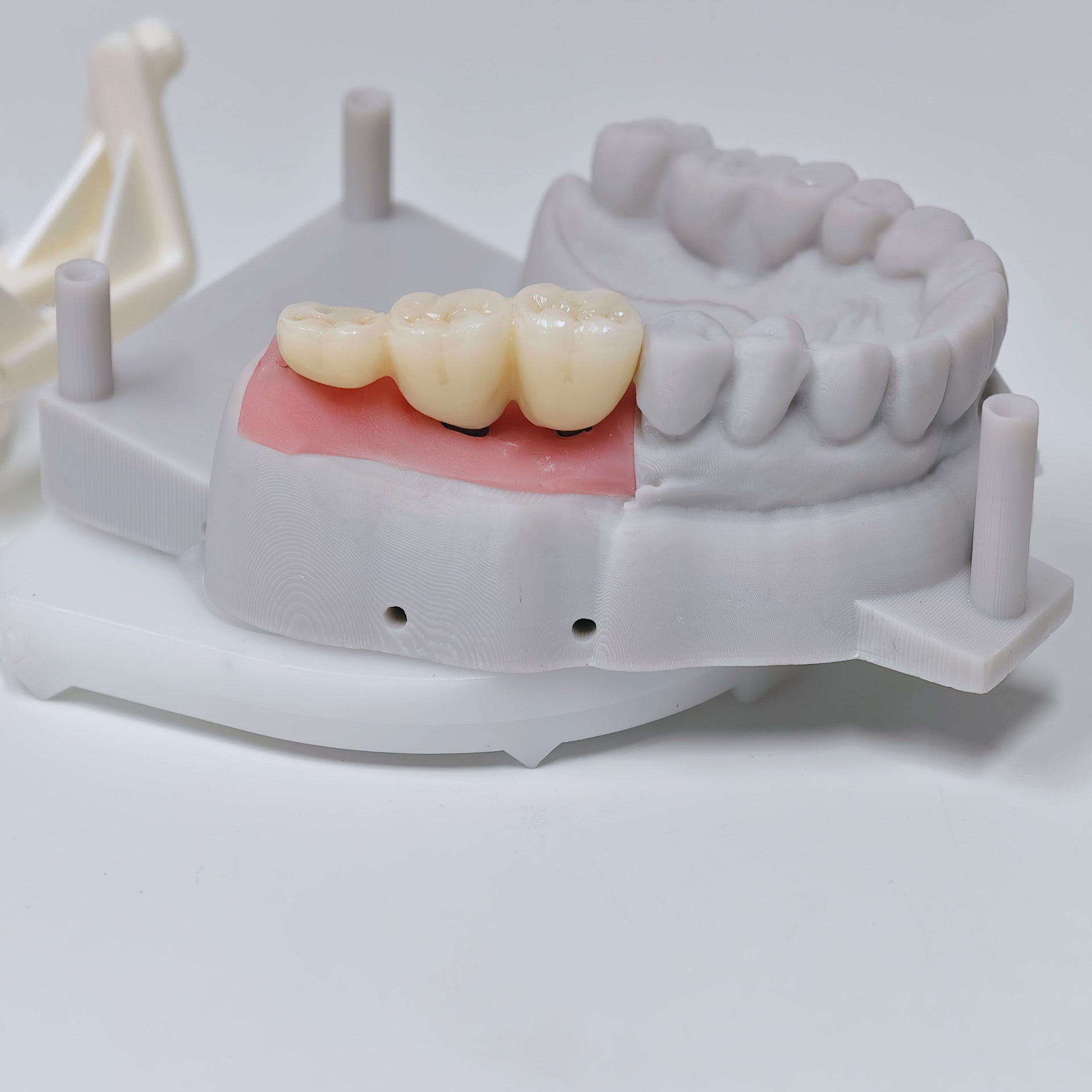 Zirconia Implant Bridge Screwmentable Dental Crown