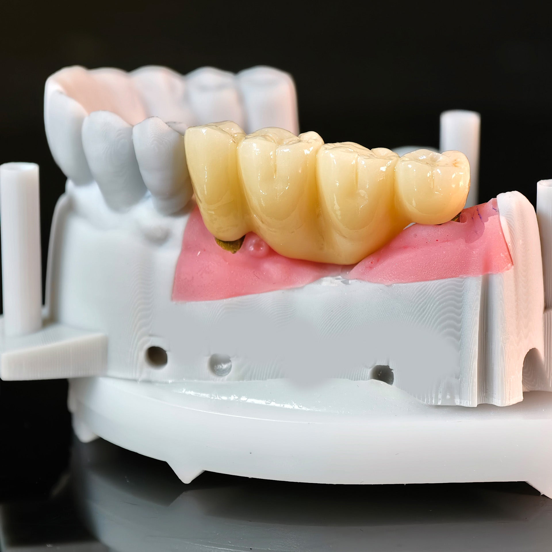 Zirconia Implant Bridge Screwmentable Dental Crown