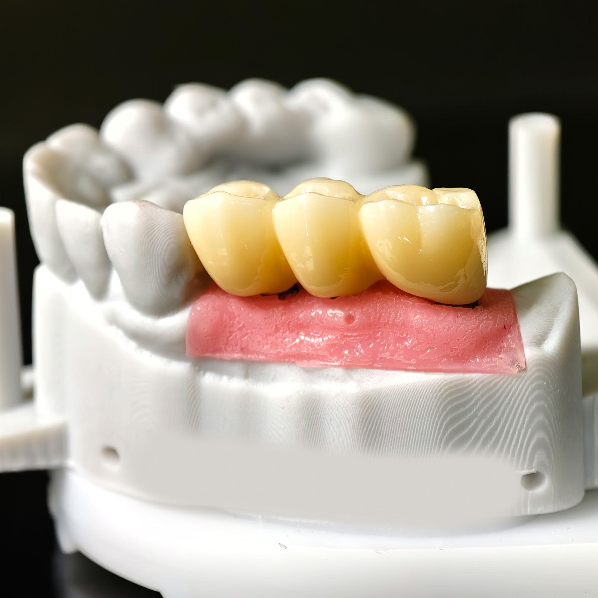 Zirconia Implant Bridge Screwmentable Dental Crown