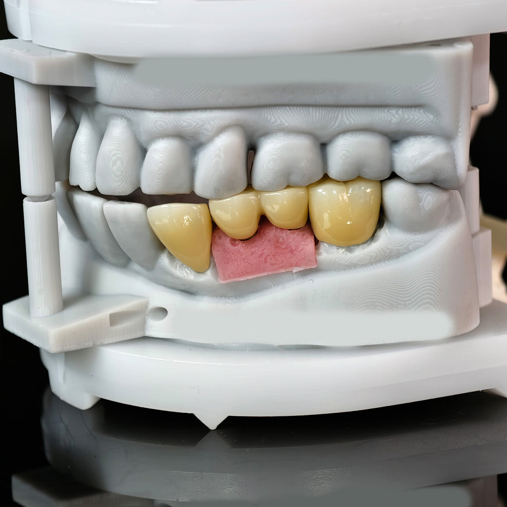 Zirconia Implant Bridge Screwmentable Dental Crown