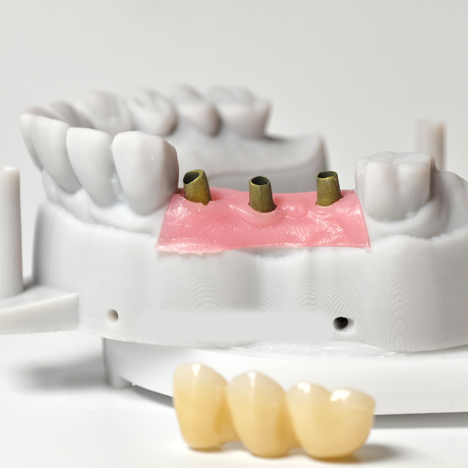 Zirconia Implant Bridge Screwmentable Dental Crown