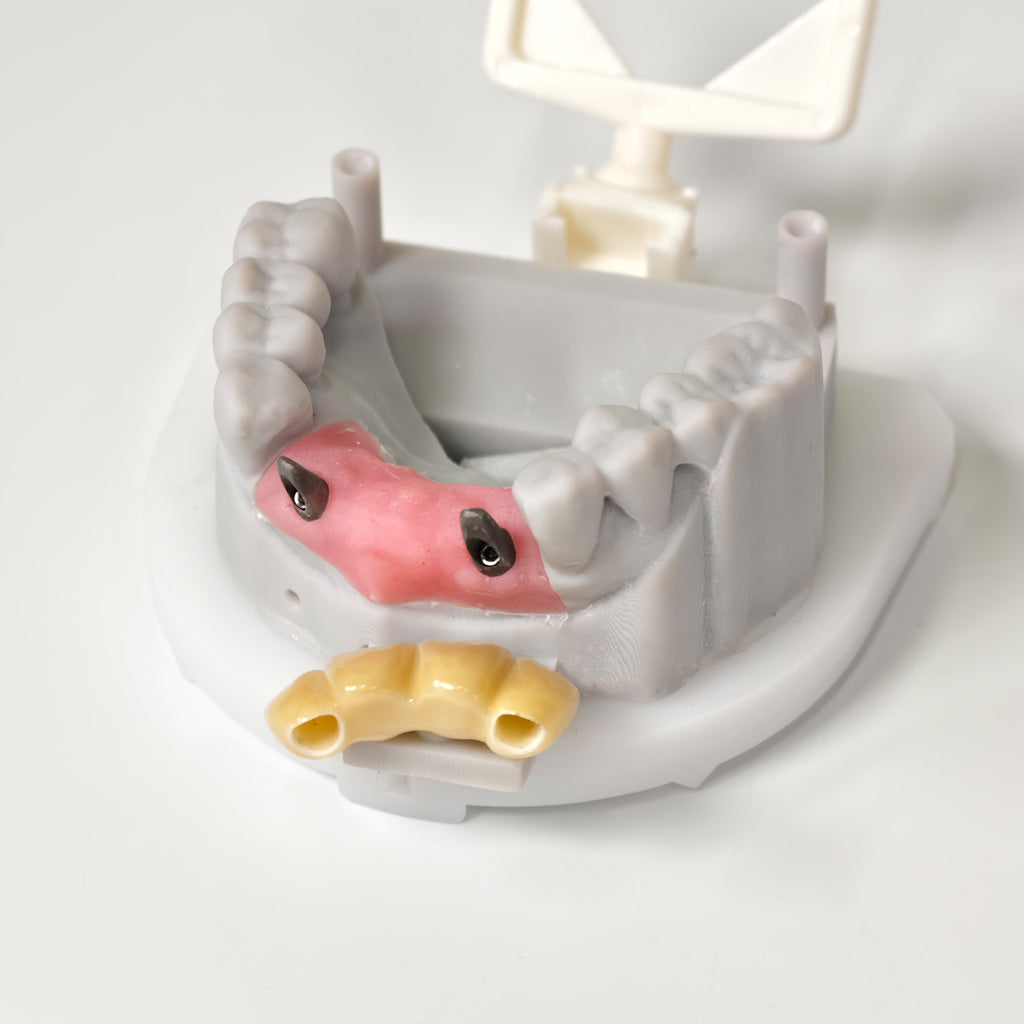 Zirconia Implant Bridge Screwmentable Dental Crown