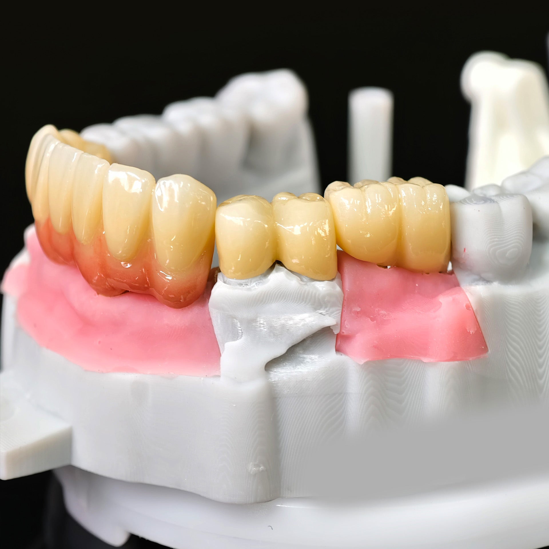 Zirconia Implant Bridge Screwmentable Dental Crown