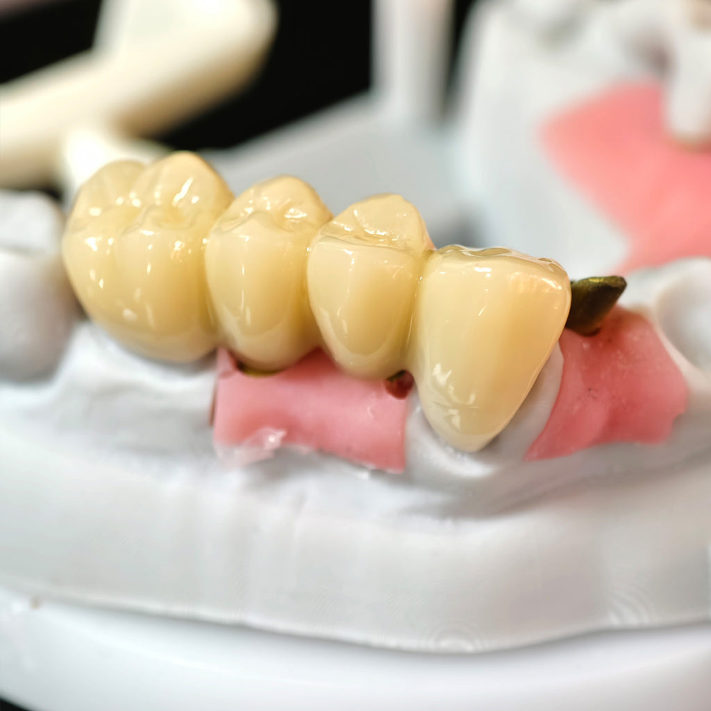 Zirconia Implant Bridge Screwmentable Dental Crown