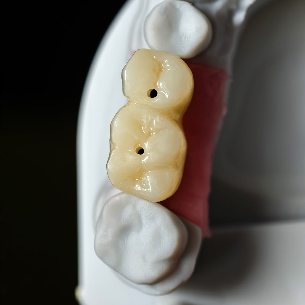 Zirconia Implant Bridge Screwmentable Dental Crown