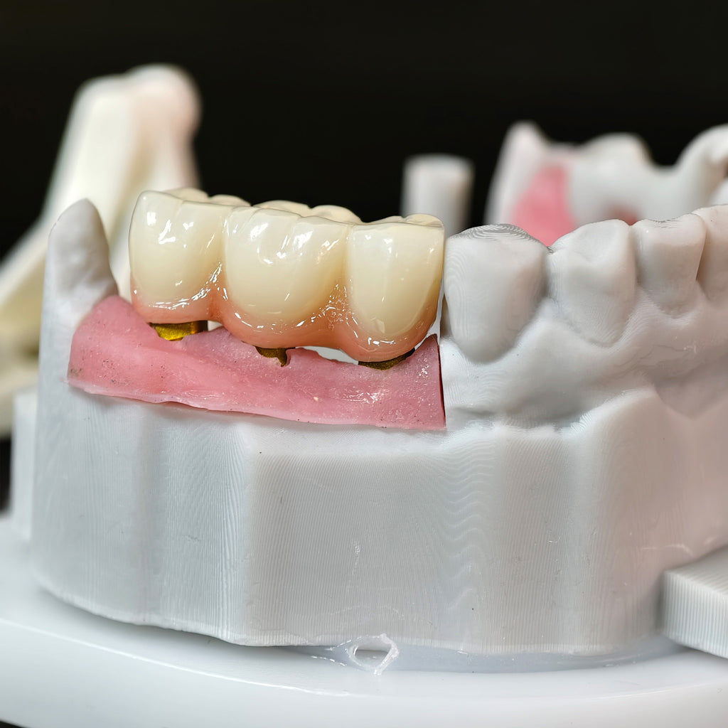 Zirconia Implant Bridge Screwmentable Dental Crown