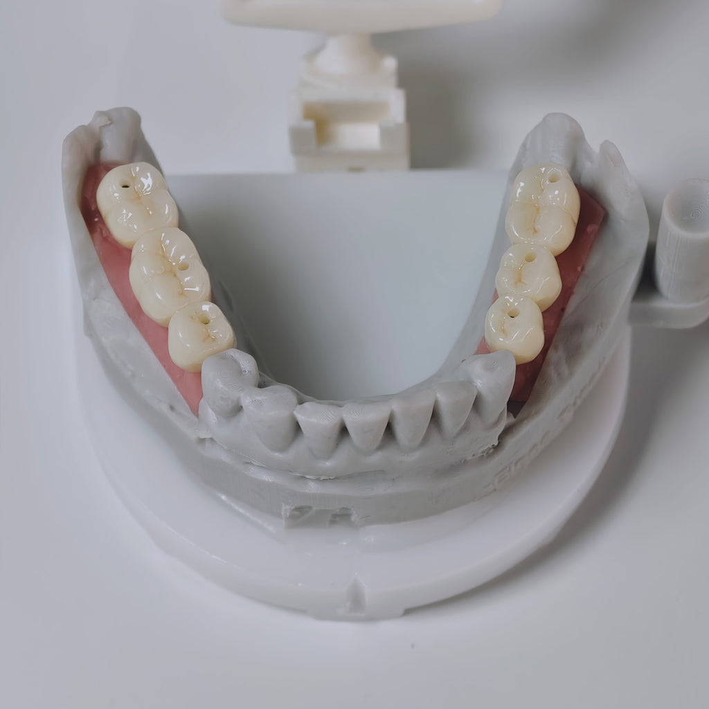 Zirconia Implant Bridges Screwmentable Dental Crown