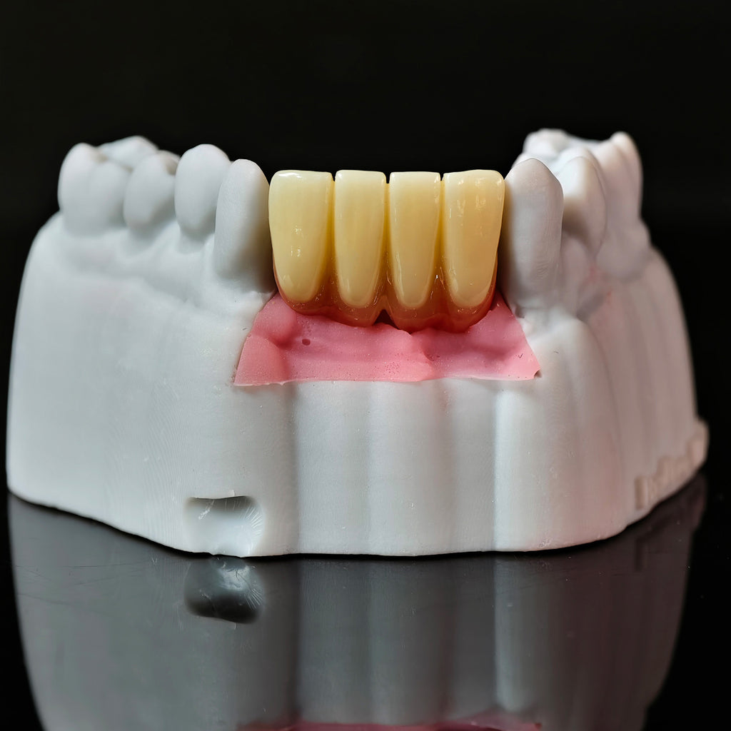 Zirconia Implant Bridge With Gold Plating