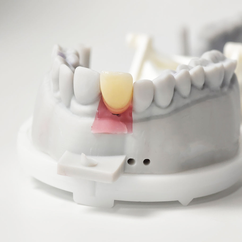 Zirconia Implant Crown Screwmentable Dental Crown