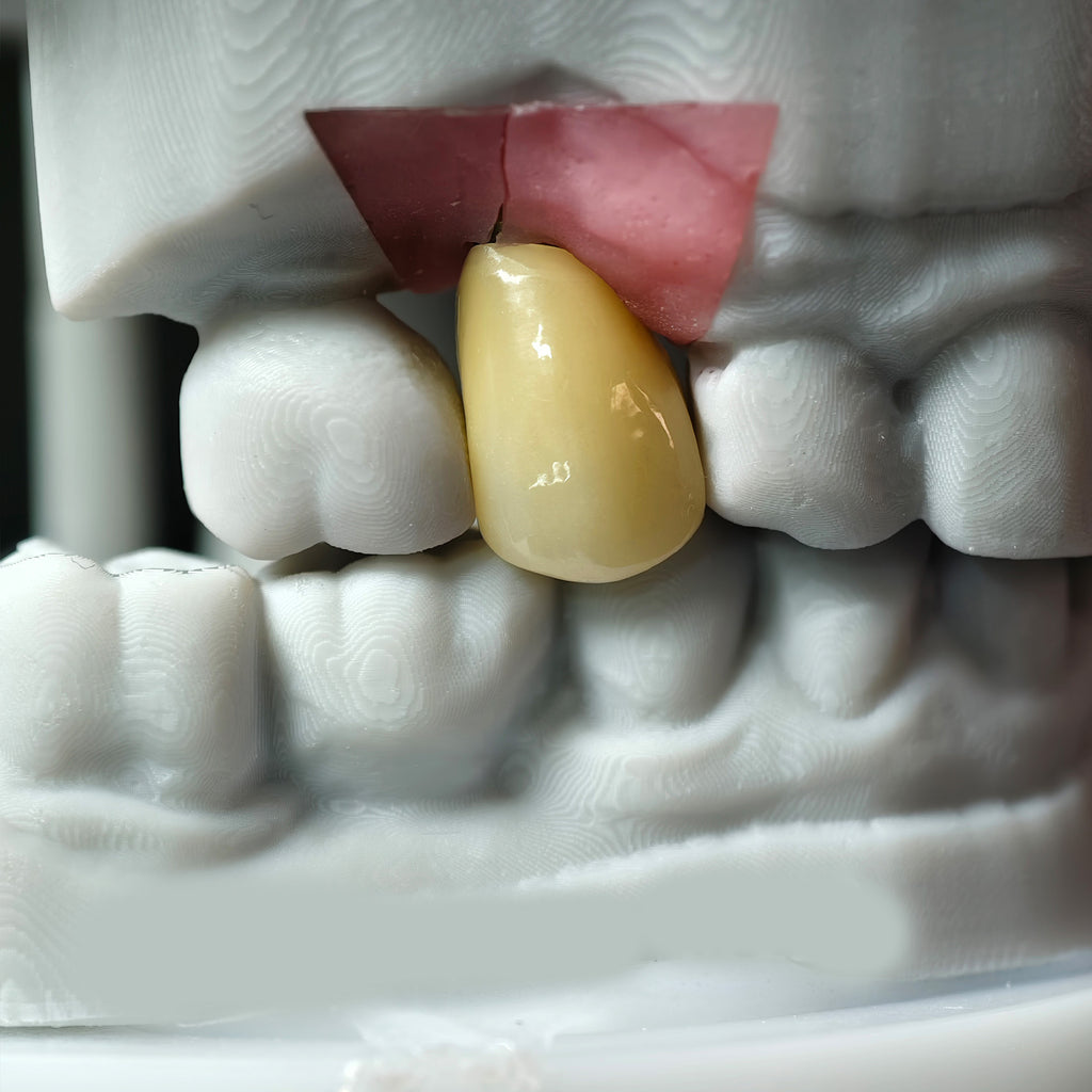 Zirconia Implant Crown Screwmentable Dental Crown