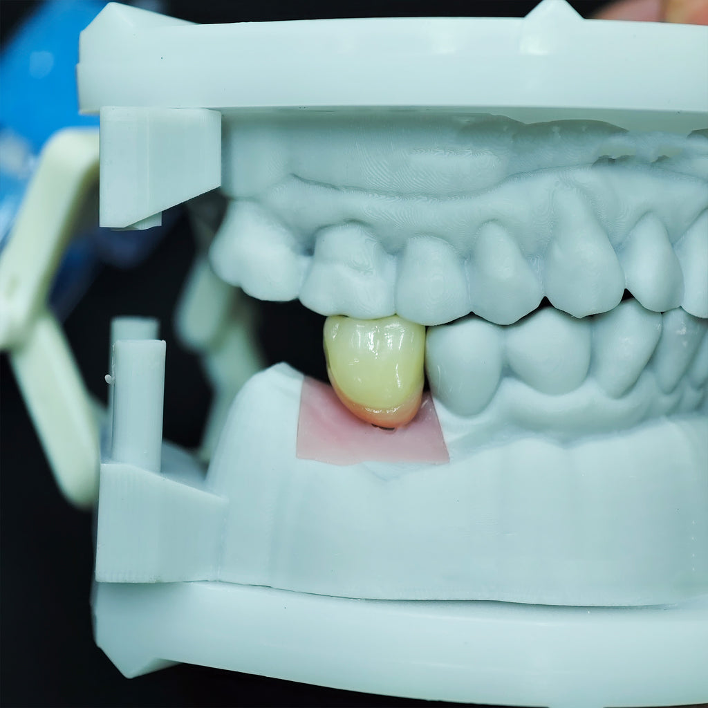 Zirconia Implant Crown Screwmentable Dental Crown