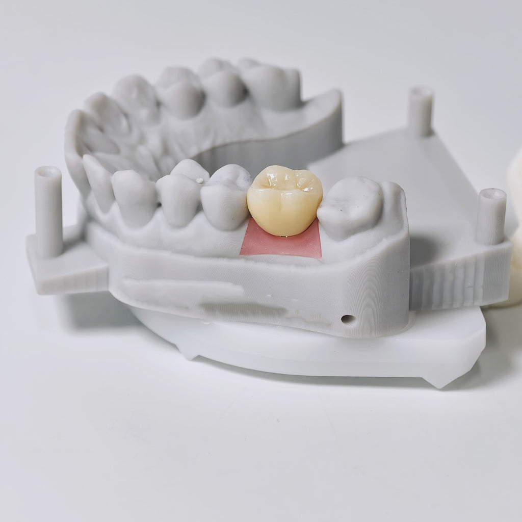 Zirconia Implant Crown Screwmentable Dental Crown