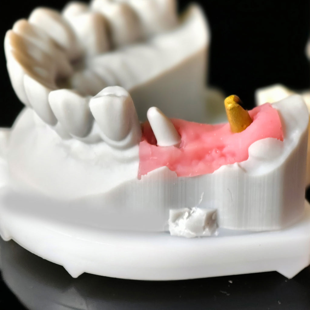 Zirconia Implant Crown Screwmentable Dental Crown