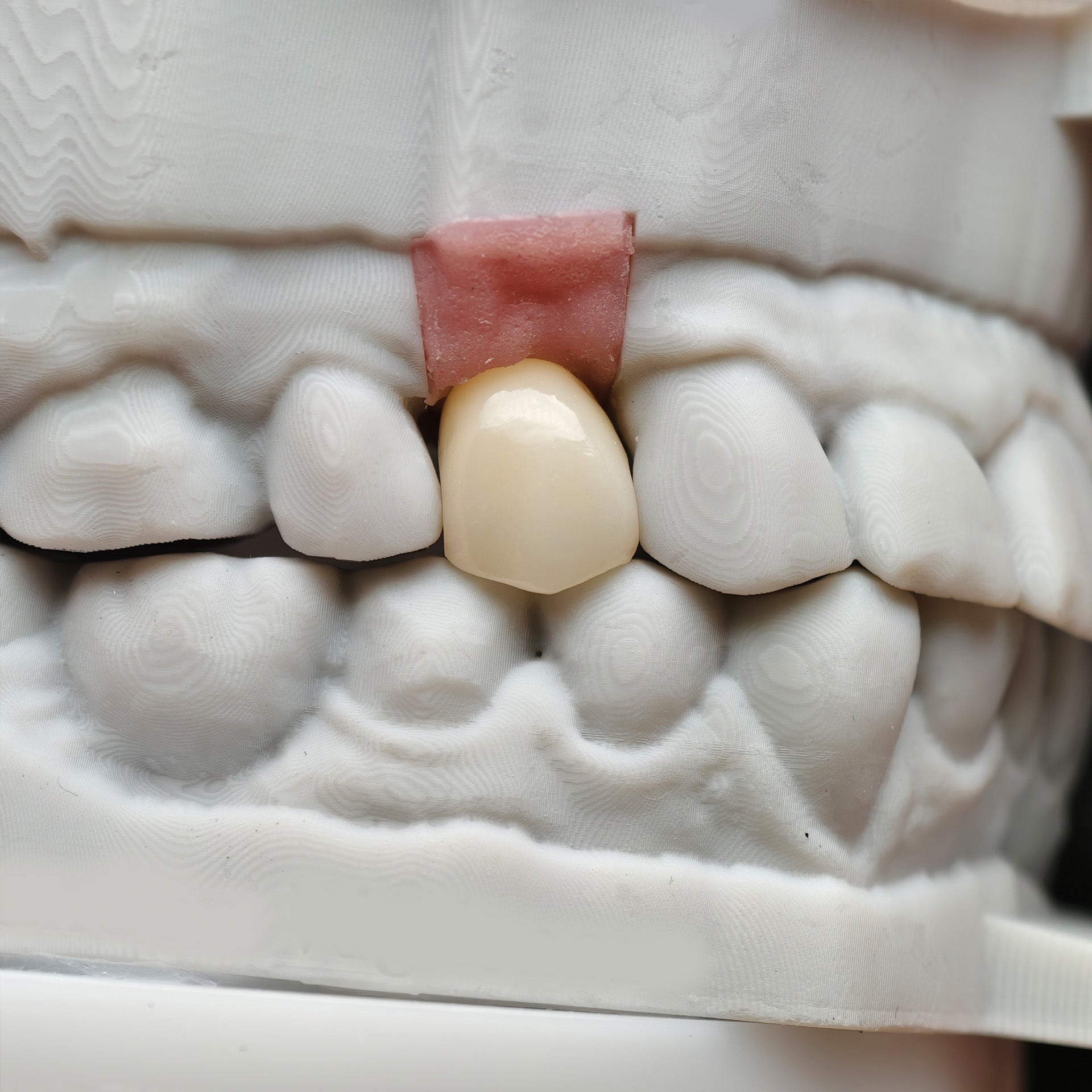 Zirconia Implant Crown Screwmentable Dental Crown