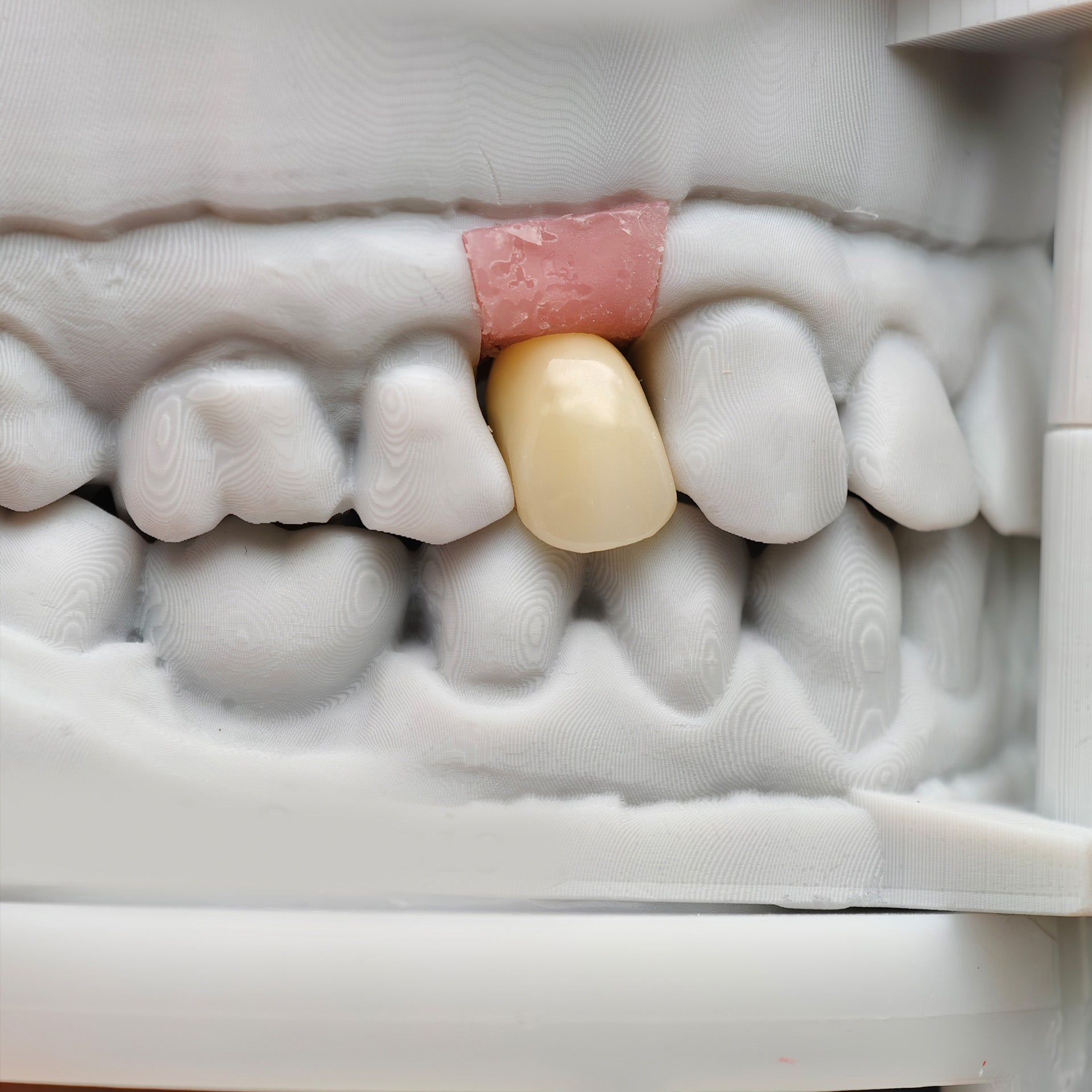 Zirconia Implant Crown Screwmentable Dental Crown