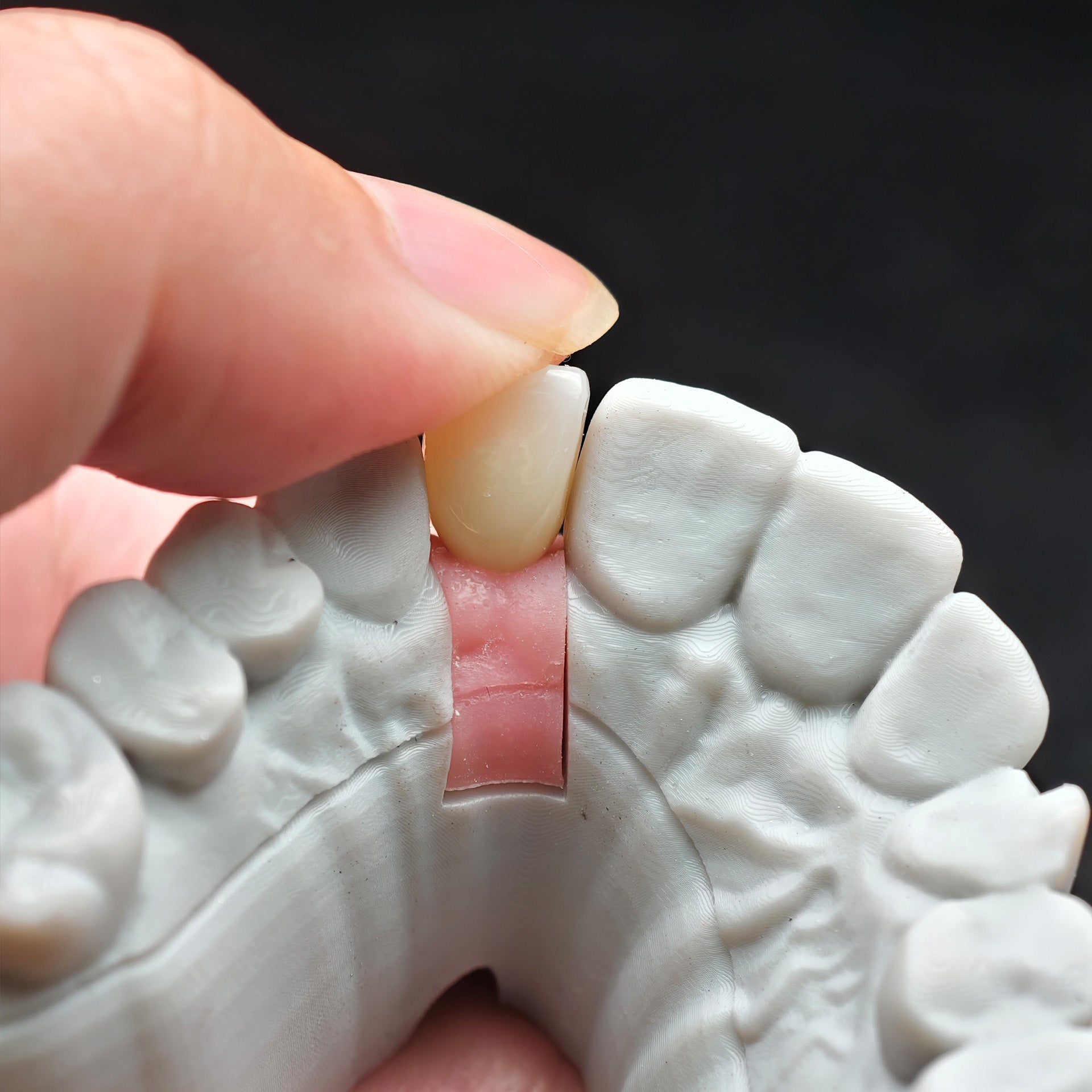 Zirconia Implant Crown Screwmentable Dental Crown