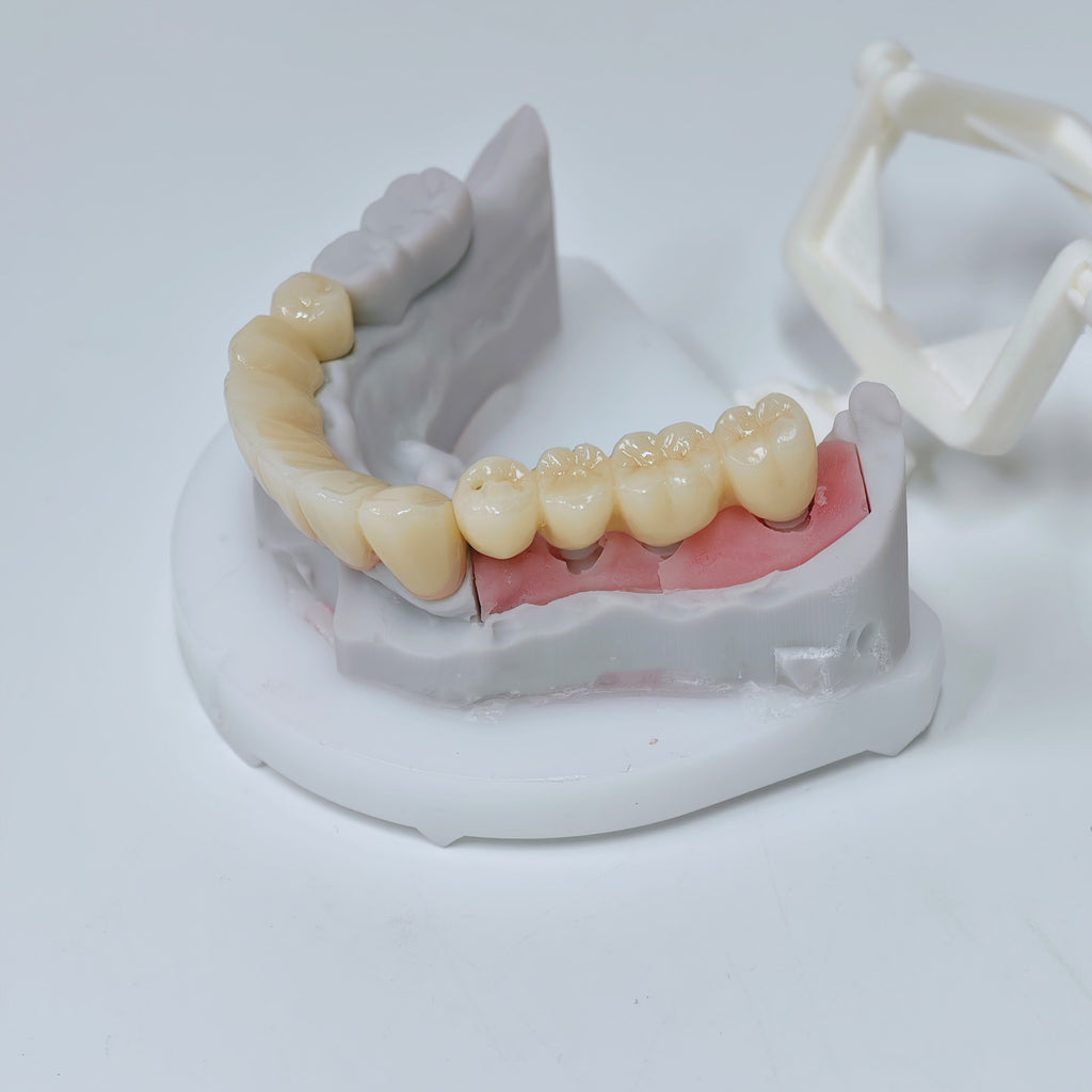 Zirconia Implant Crown And Bridges Screwmentable Dental Crown