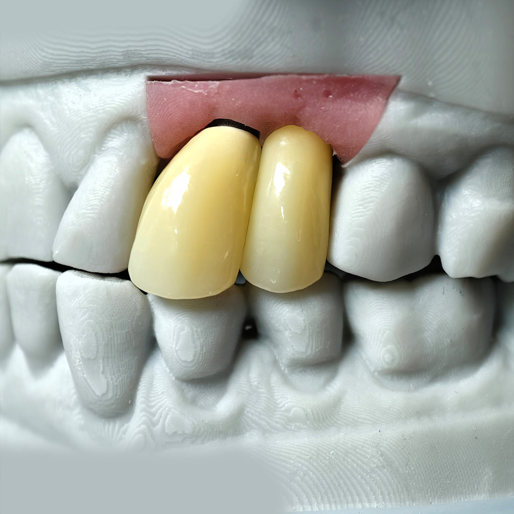 Zirconia Implant Crowns Screwmentable Dental Crown With Gold Plating
