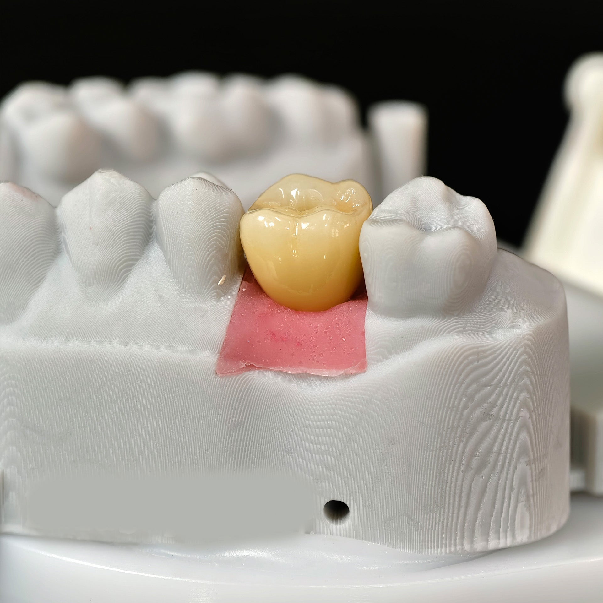 Zirconia Implant Crown With Gold Plating