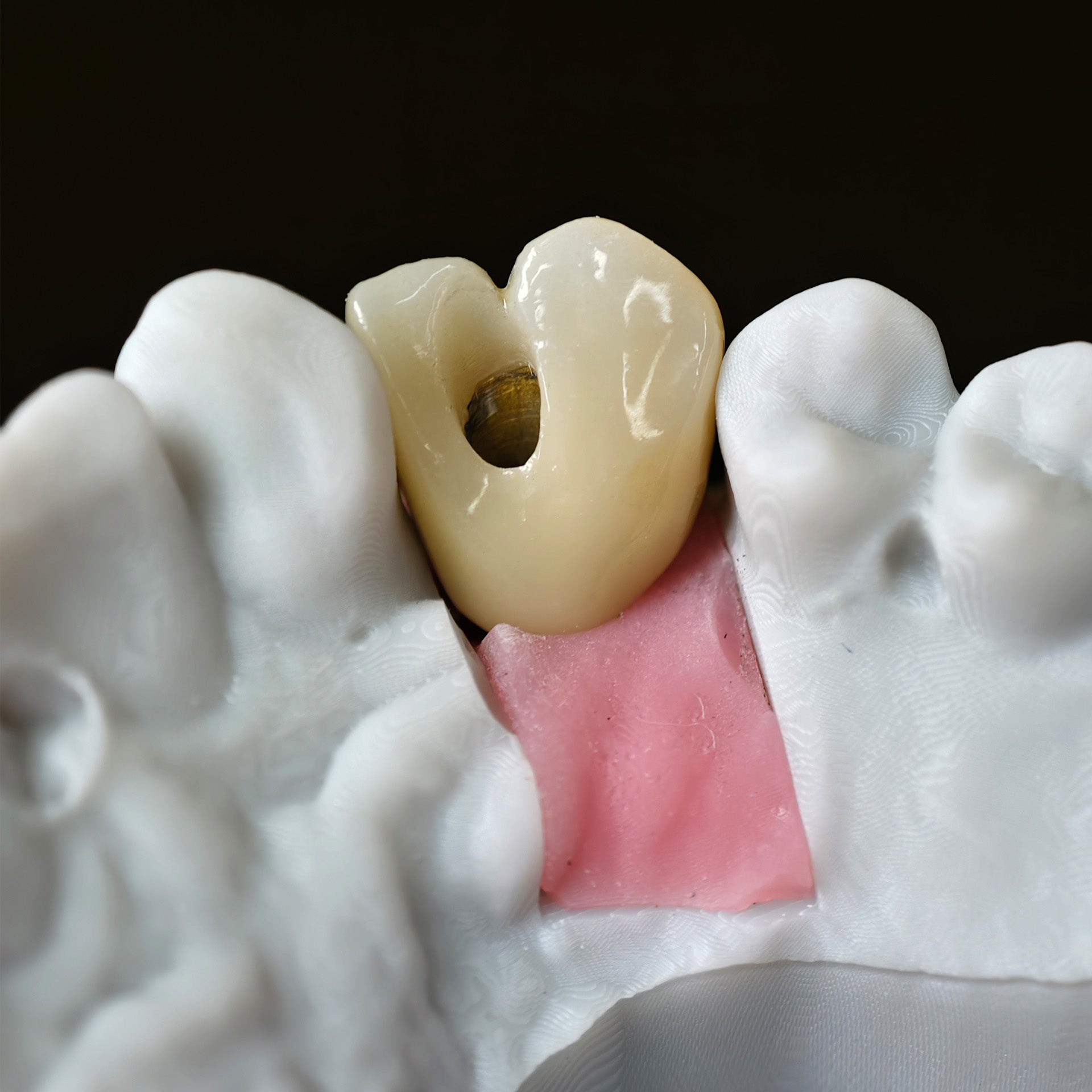 Zirconia Implant Crown With Gold Plating