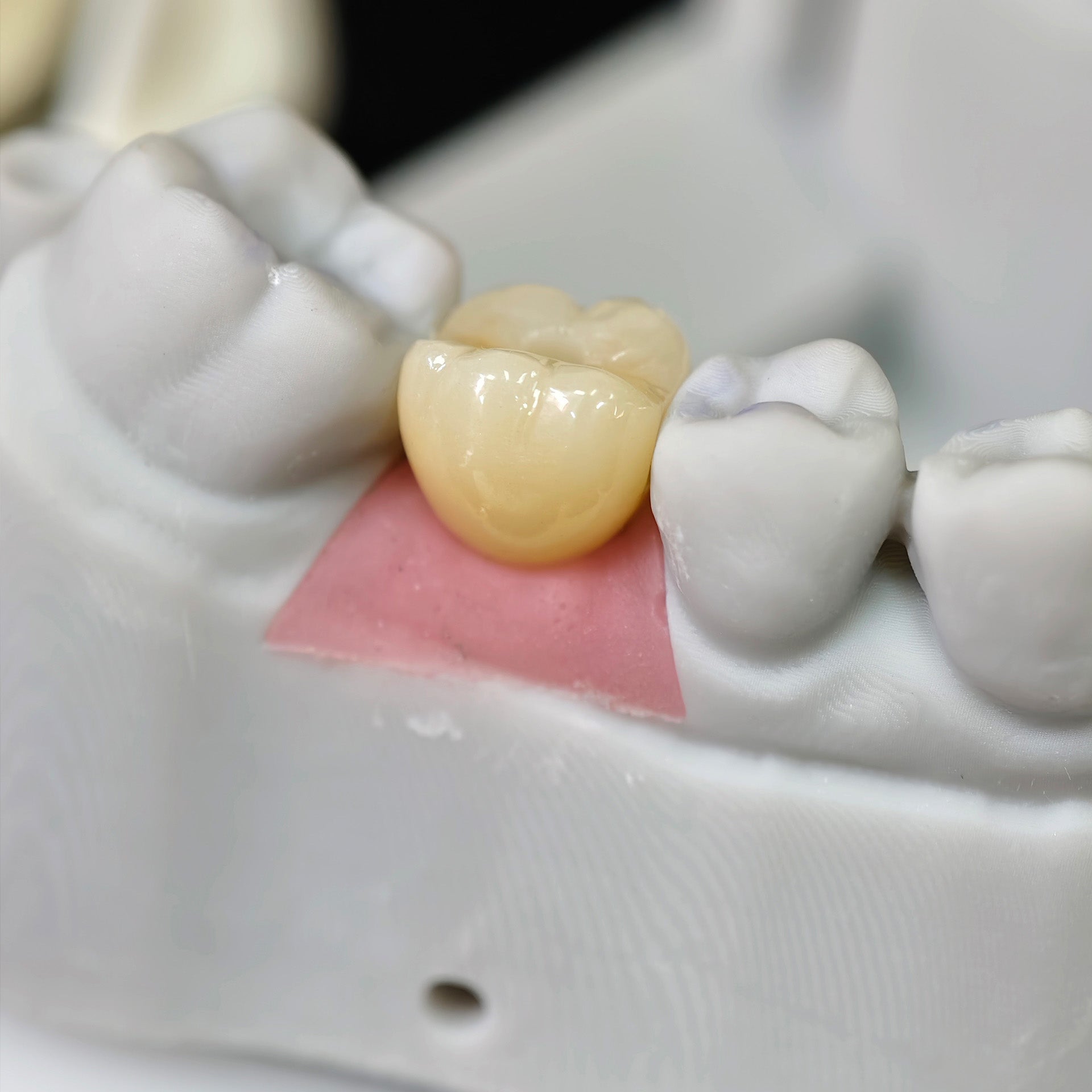 Zirconia Implant Crown With Gold Plating