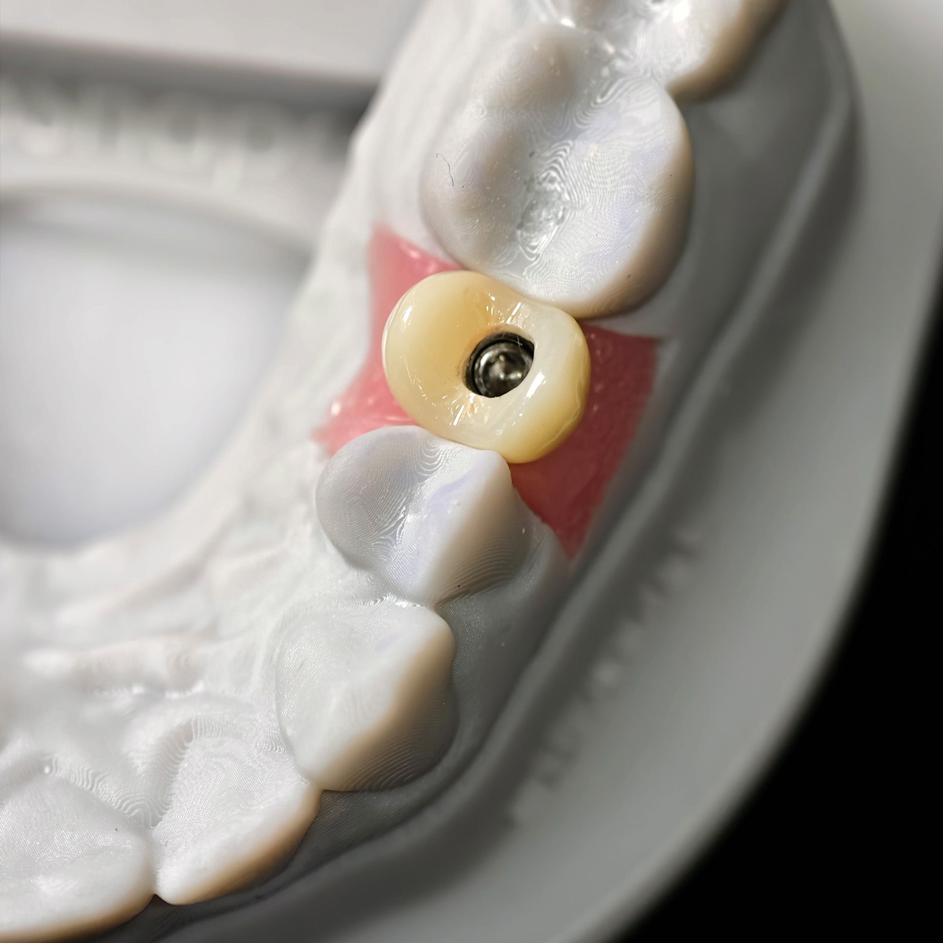 Zirconia Implant Crown With Gold Plating